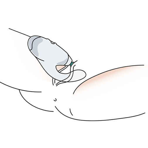 Gently insert the stimulator into your vagina and surround your clitoris with the stimulation head. 